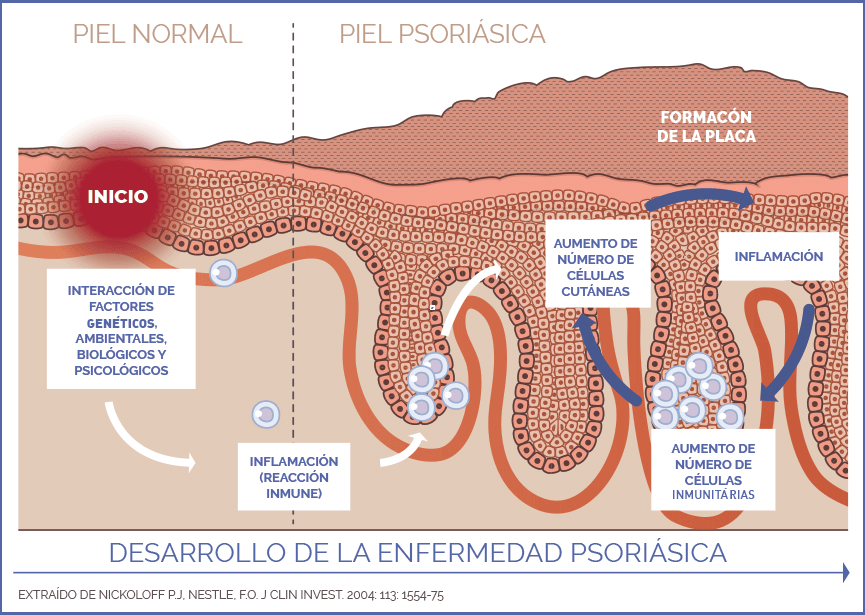 psoriasis